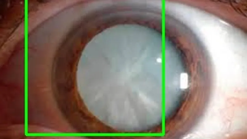 cataract_found